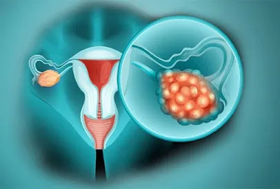 Fighting Ovarian Cancer